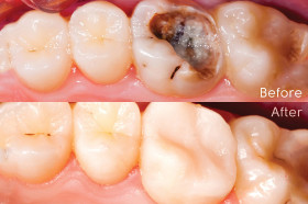 composite restorations  - Hadir Khalid 's clinic