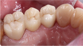 zirconia crowns  - Hadir Khalid 's clinic