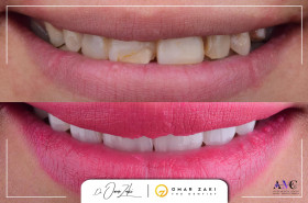 E-max veneers  - Hadir Khalid 's clinic