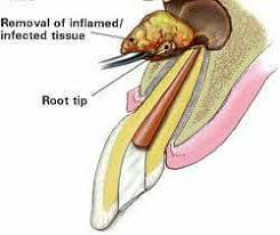 cyst removal  - Adham Yehia 's clinic